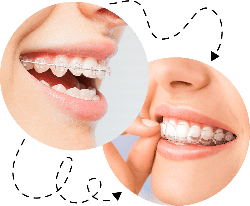 Invisalign Vs Braces - Which Is The Best Orthodontic Treatment For Your  Smile - Sandy Smiles Orthodontics