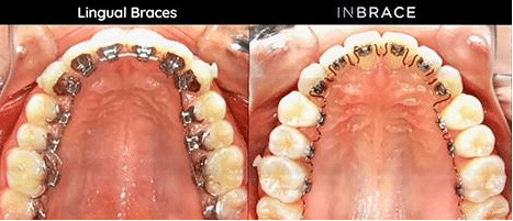 Braces vs Inbrace at Moorestown Orthodontics Moorestown NJ